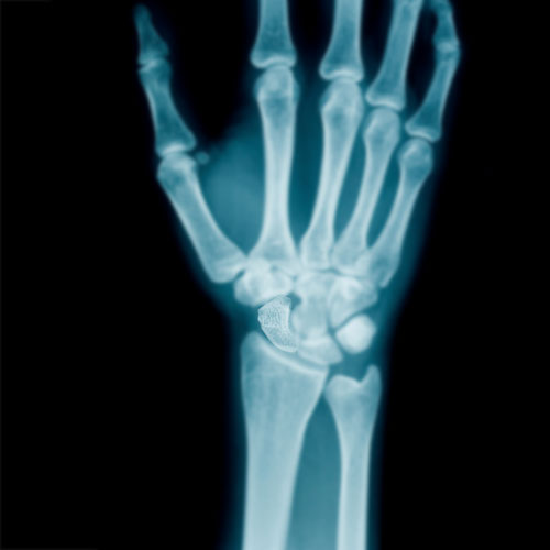 Body Parts answer: SCAPHOID